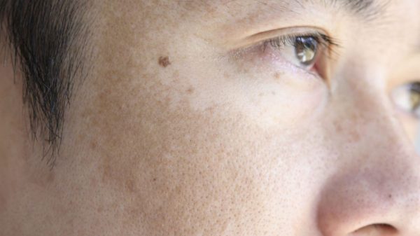 melasma:-conheca-os-principais-sintomas-e-saiba-como-prevenir-e-tratar