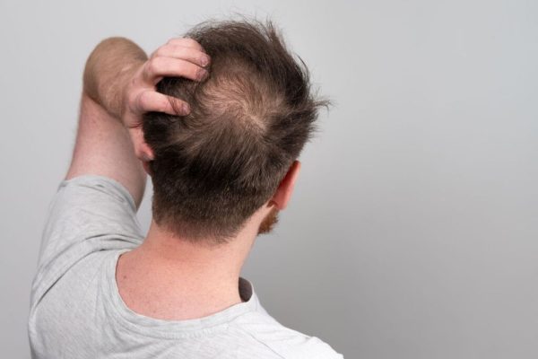 minoxidil,-finasterida-e-outros:-beneficios-e-riscos-de-medicamentos-contra-a-calvicie