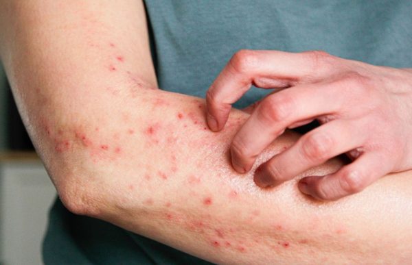 mpox:-eczema-na-pele-pode-agravar-infeccao,-diz-virologista