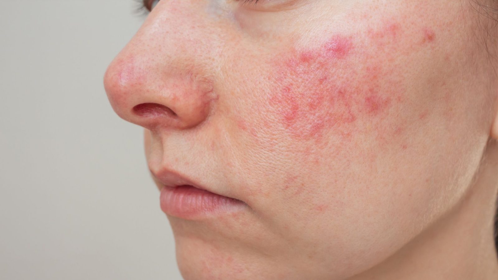 rosacea:-saiba-o-que-e-e-como-ajustar-rotina-de-cuidados-para-tratar-doenca