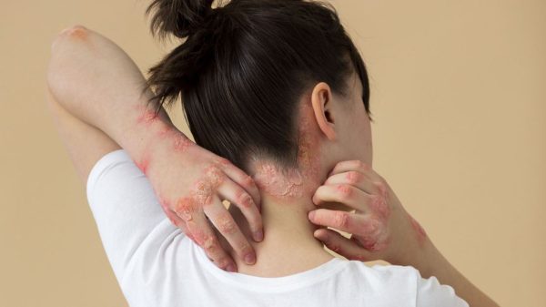 psoriase:-o-que-e,-quais-sao-os-sintomas,-tratamentos-e-prevencao