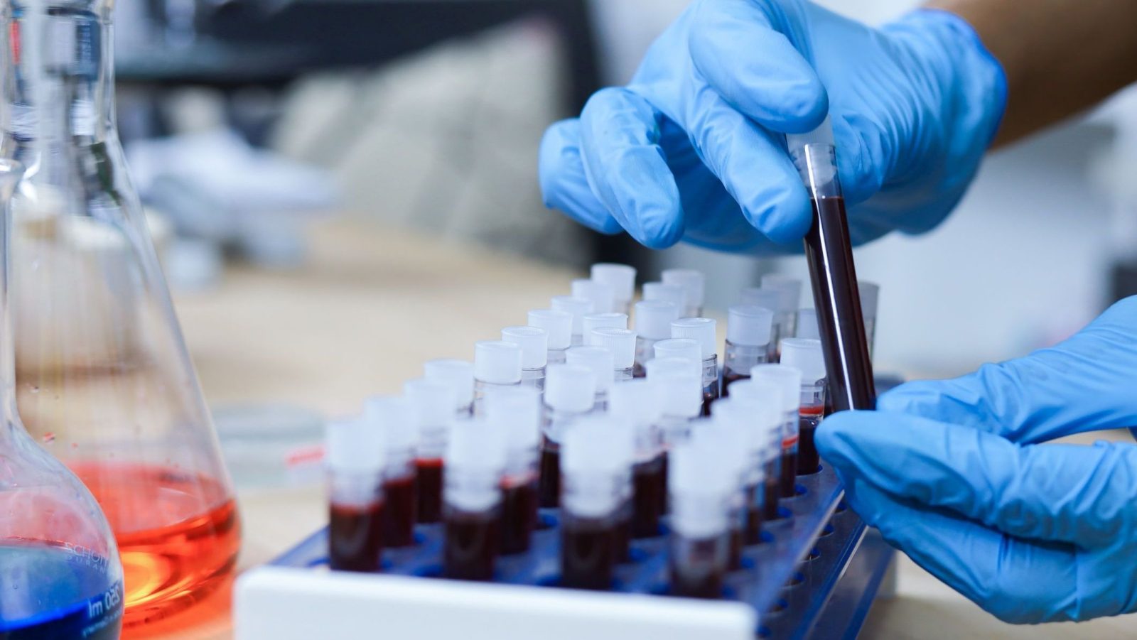 cancer-de-prostata:-exame-de-sangue-pode-prever-tempo-de-sobrevivencia