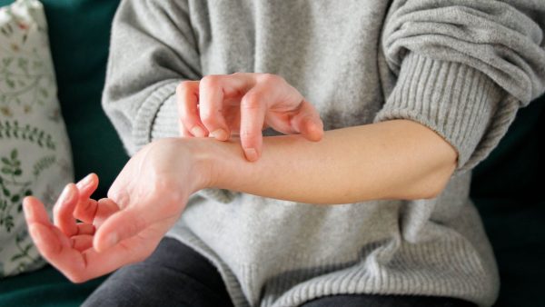dermatite-atopica:-novo-medicamento-e-opcao-para-casos-moderados-e-graves