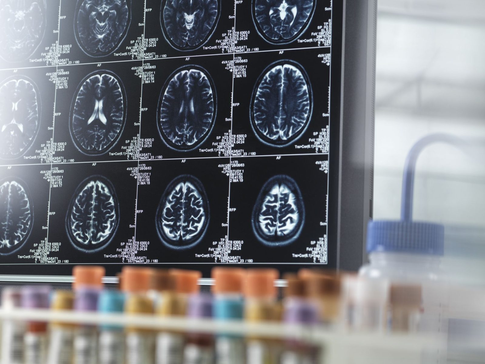 cientistas-descobrem-como-“ouvir”-sintomas-de-alzheimer;-entenda