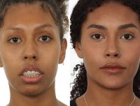 romana-novais,-esposa-de-alok,-faz-rinoplastia-estruturada;-entenda-o-que-e