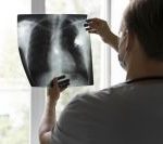 gene-envolvido-no-cancer-de-pulmao-e-descoberto-por-novo-estudo